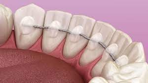 prosedur splinting gigi untuk menstabilkan gigi goyang