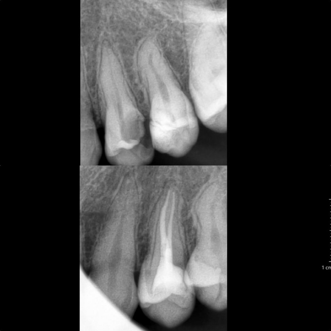 Hasil endodontic treatment atau PSA di Klinik Utama Pondok Gigi Jakarta