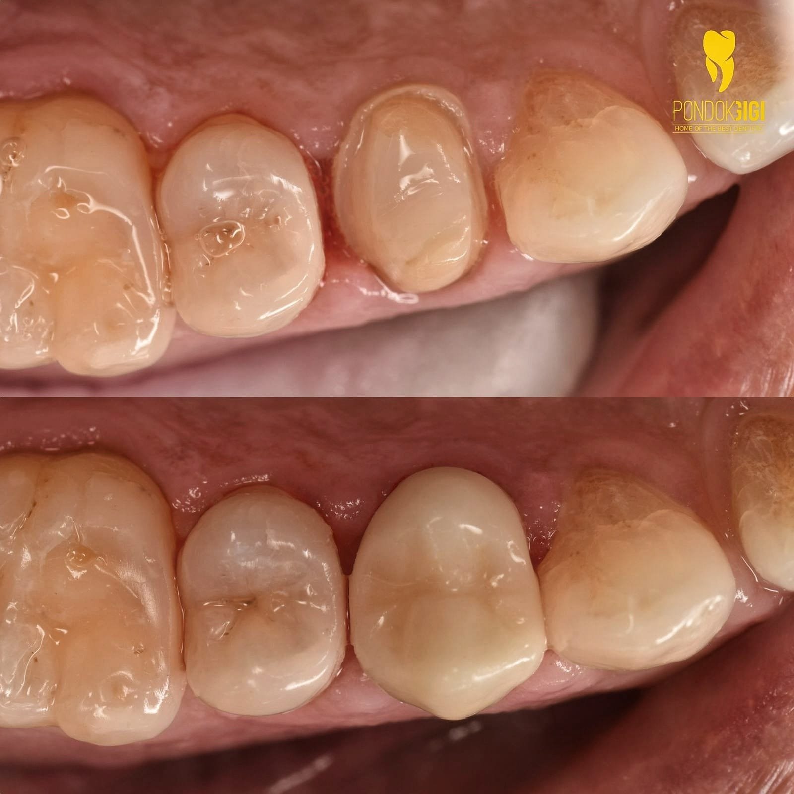 pemasangan crown gigi di klinik utama pondok gigi jakarta