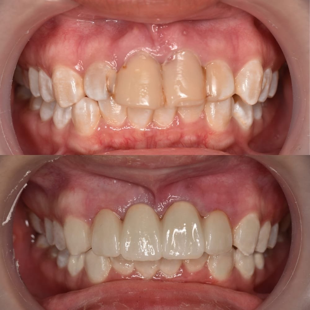 Contoh hasil crown gigi zirconia di jakarta