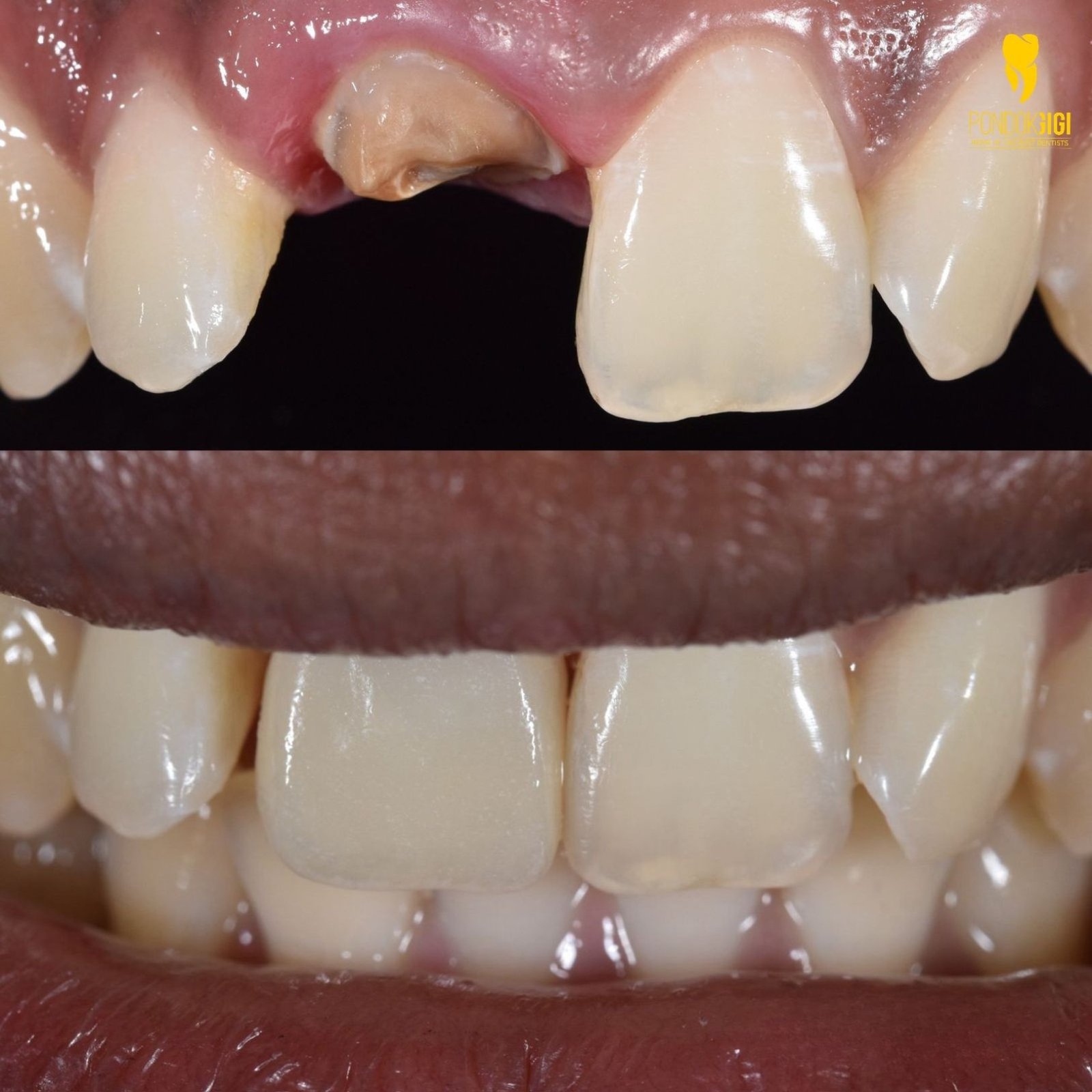 Hasil before after crown gigi pasien di jakarta
